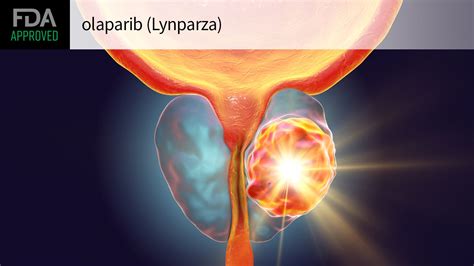 FDA OKs Olaparib-Abiraterone for Metastatic Prostate Cancer | MedPage Today