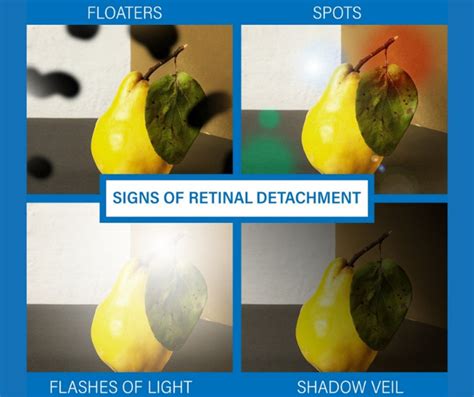 Retinal Detachment Vision