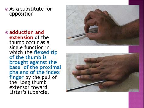 Ape thumb deformity to publish