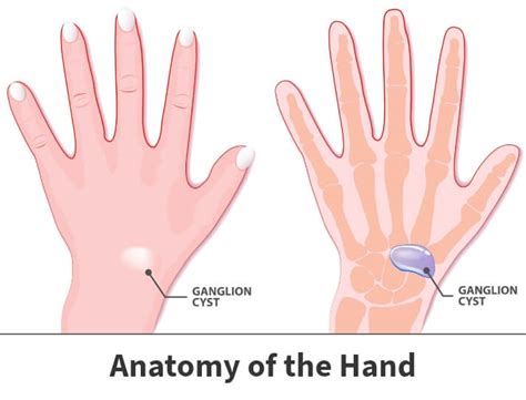 Ganglion Cyst Appearance | sexiezpix Web Porn