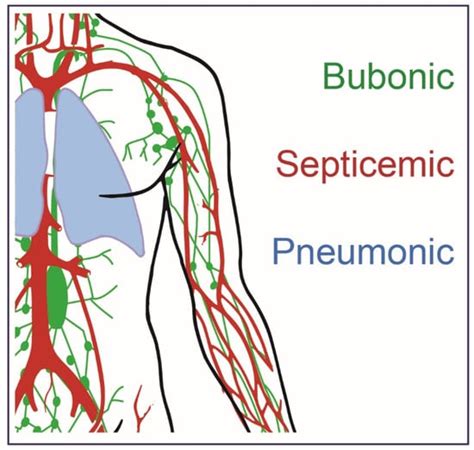 Septicemic Plague Symptoms