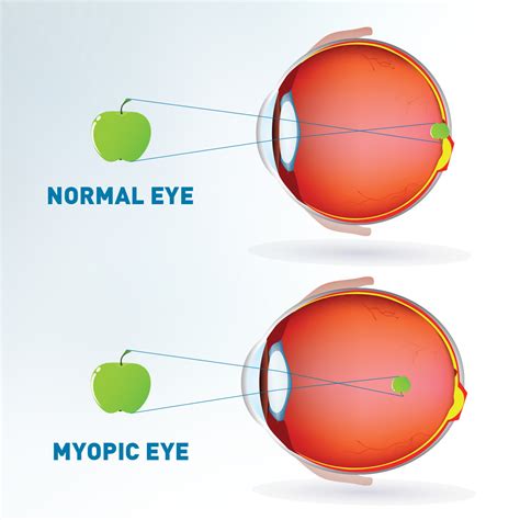 Myopia Control - Richard Hughes Opticians