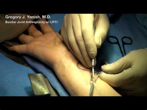 Thumb Basilar Joint Arthroplasty with LRTI - YouTube