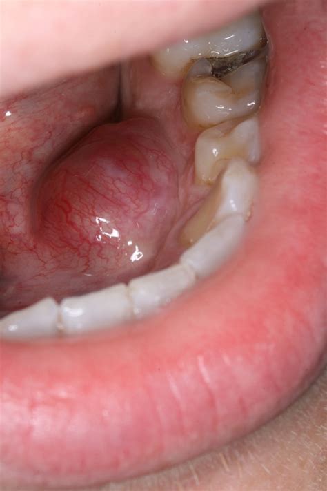 Floor Of Mouth Swollen After Tooth Extraction | Review Home Decor