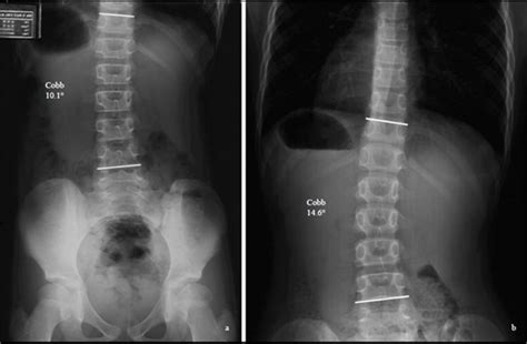 Intervention Observation in Mild Idiopathic Scoliosis in Skeletally Immature Patients