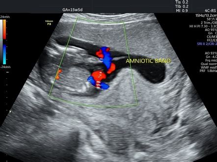 Amniotic band syndrome | Image | Radiopaedia.org