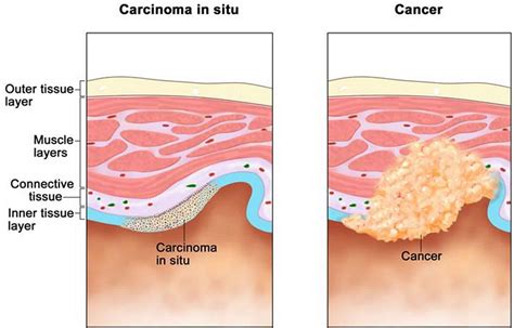 Carcinoma in situ definition, breast, skin, cervix & bladder