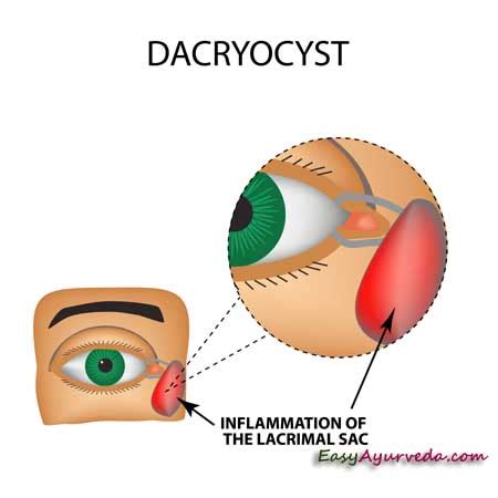 Lacrimal Cyst – Causes, Symptoms, Complications, Prognosis, Treatment