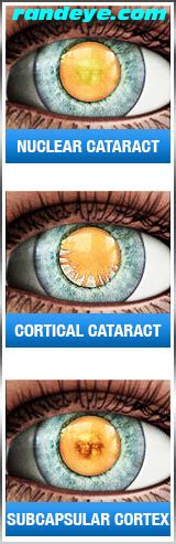 Types of Cataracts | Rand Eye Institute