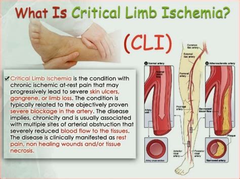 Critical Limb Ischemia Symptoms