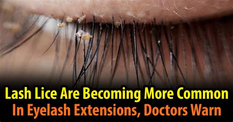 Lash Lice Are Becoming More Common In Eyelash Extensions, Doctors Warn ...