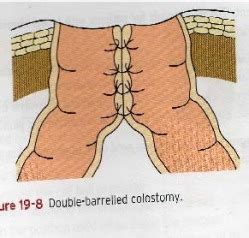 Colostomy Techniques - Colostomy Care