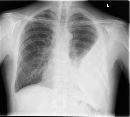 Pleural Empyema