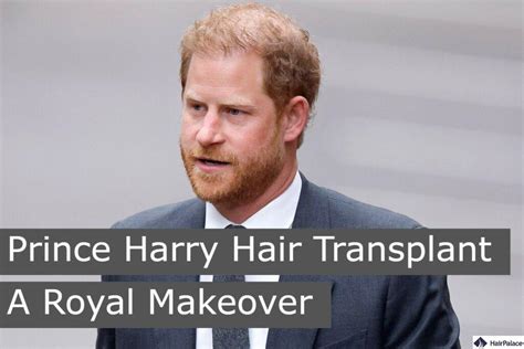 Prince Harry Hair Transplant | A Royal Makeover