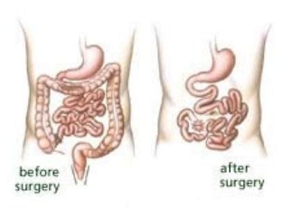 Panproctocolectomy and Ileostomy - Milton Keynes University Hospital