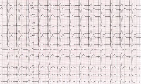 ECG and dual chamber pacemaker - MicroPort Academy