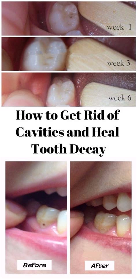 How to Get Rid of Cavities and Heal Tooth Decay - Health And Beauty Queen