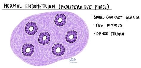 Atypical endometrial hyperplasia - MyPathologyReport.ca