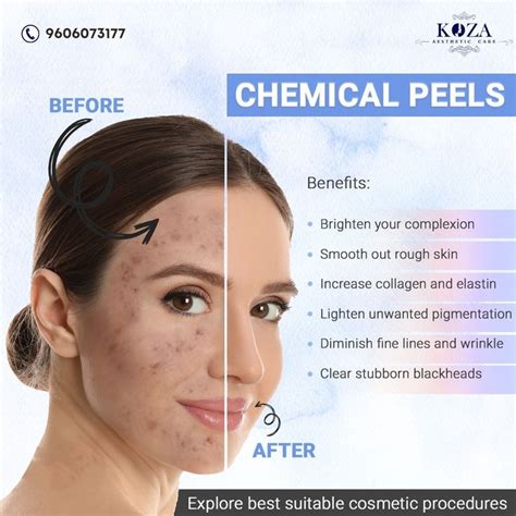 Chemical peel benefits and side effects - editfery