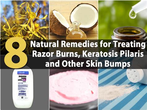 8 Natural Remedies for Treating Razor Burns, Keratosis Pilaris and Other Skin Bumps - DIY & Crafts