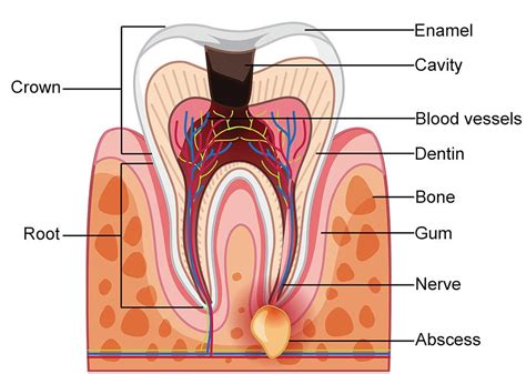 Tooth Abscess Stages: A Comprehensive Overview