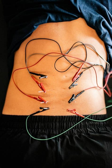 Dry Needling vs Acupuncture: Main Similarities & Differences