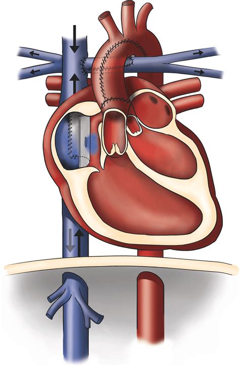 Schematic drawing of the Fontan circulation as established in a patient ...