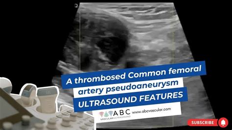 A thrombosed Common femoral artery pseudoaneurysm: ultrasound features ...