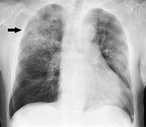 Pneumonia - Wikipedia