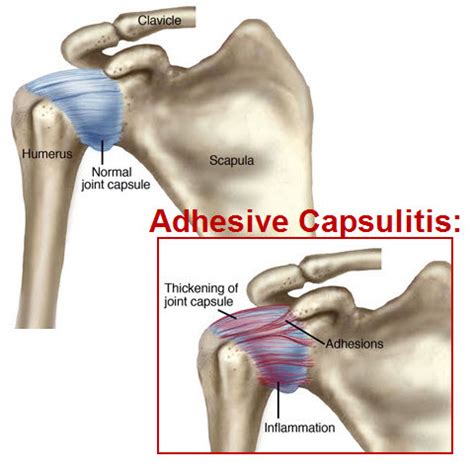 Adhesive Capsulitis or Frozen Shoulder - Causes, Symptoms and Treatment | Bone and Spine