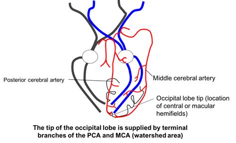 Superior homonymous quadrantanopia – Case-Based Neuro-Ophthalmology