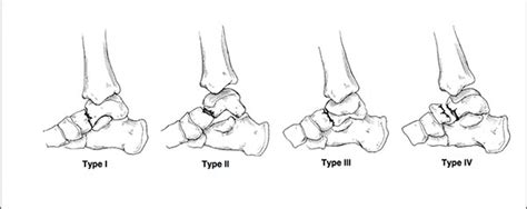 The Diagnosis, Management and Complications Associated with Fractures ...