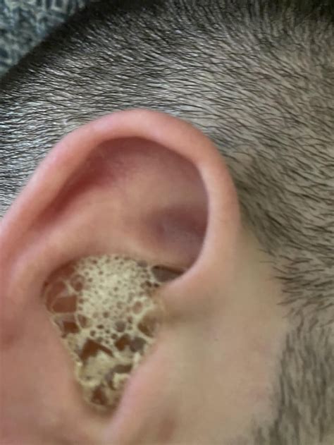 Blocked ear + Peroxide : r/earwax