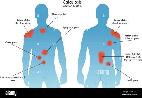 Kidney pain location diagram