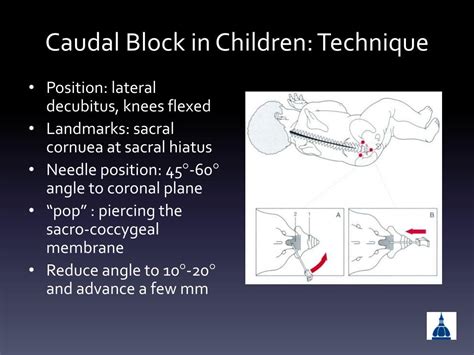 Caudal Anesthesia Technique