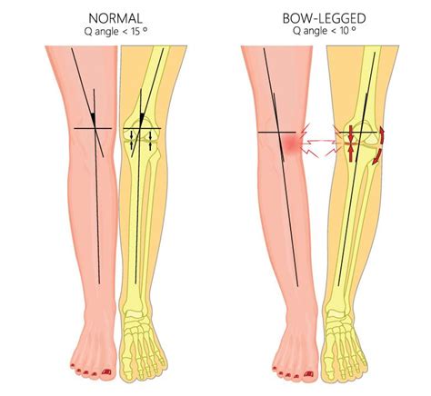 Bow Legs (Genu Varum) - Symptoms & Causes | Mount Elizabeth Hospitals