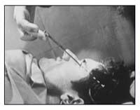 Lobotomy History & Procedure | Study.com