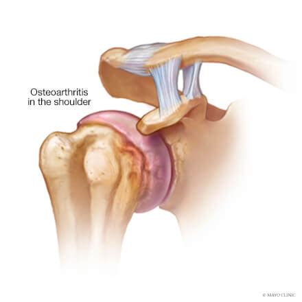 Glenohumeral Joint Degeneration