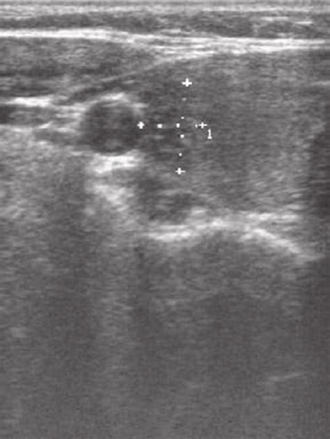 An isoechogenic thyroid nodule, with regular borders and no... | Download Scientific Diagram