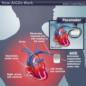 What's an AICD, and how could it save your life? | HowStuffWorks