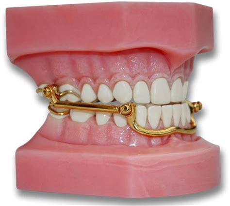 The Best Mandibular Advancement Device for Sleep Apnea and Snoring