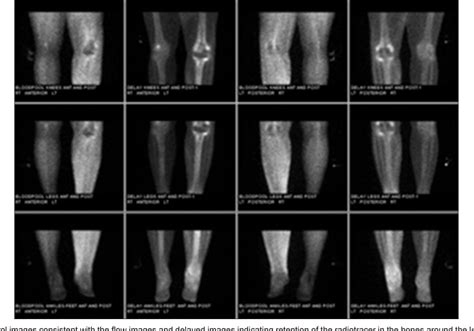 Figure 2 from Three phase bone scan interpretation based upon vascular ...