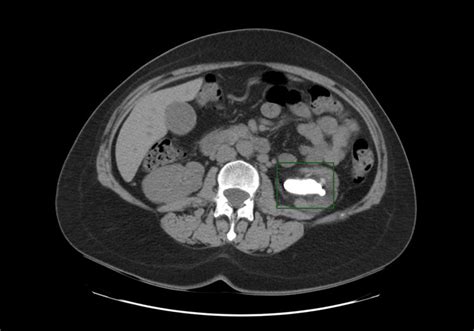 Kidney stone CT - wikidoc