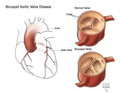 Bicuspid aortic valve . Causes, symptoms, treatment Bicuspid aortic valve