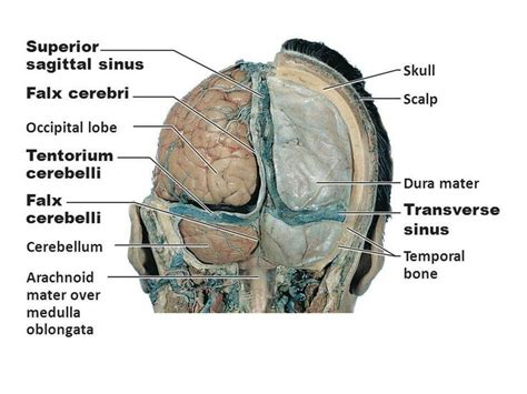 Note: falx cerebri and tentorium cerebelli | Medical anatomy, Human ...