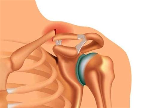 14 Common Causes of Collarbone Pain and How to Treat Them