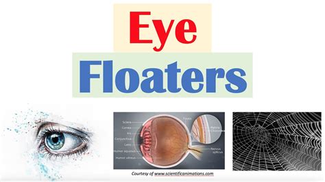 Vitreous Floaters