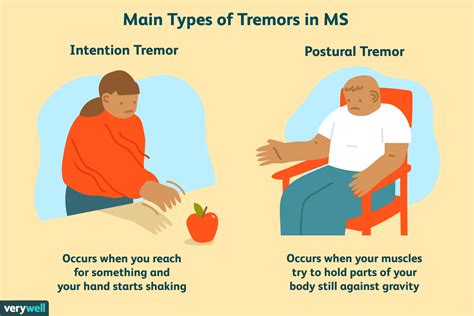 Temblor como síntoma de esclerosis múltiple - Medicina Básica