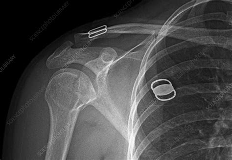 Humerus fracture, X-ray - Stock Image - F036/0235 - Science Photo Library