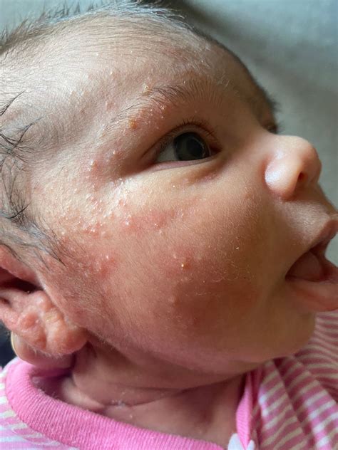 Rashes on newborns face | BabyCenter